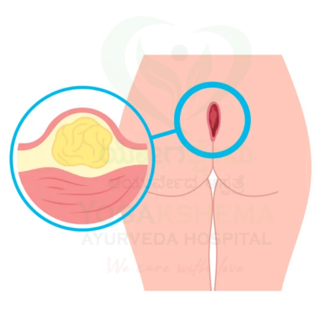 Pilonidal Disease